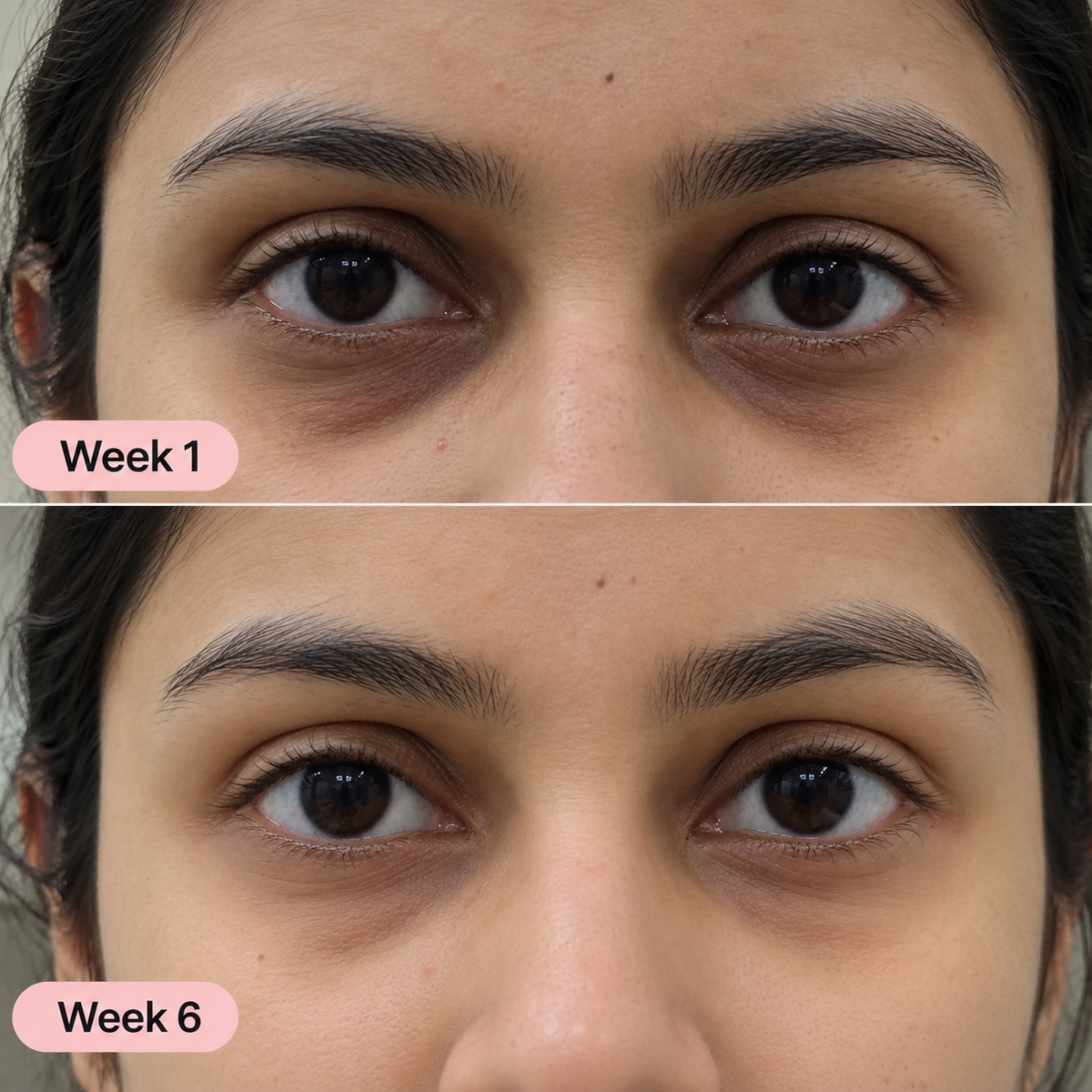 Korean Micro-needling Eye Patches